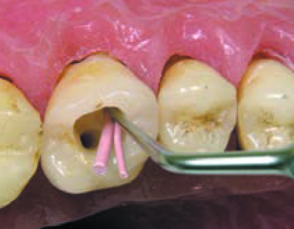 Acteon SO4 – Насадка для латеральной конденсации гуттаперчи