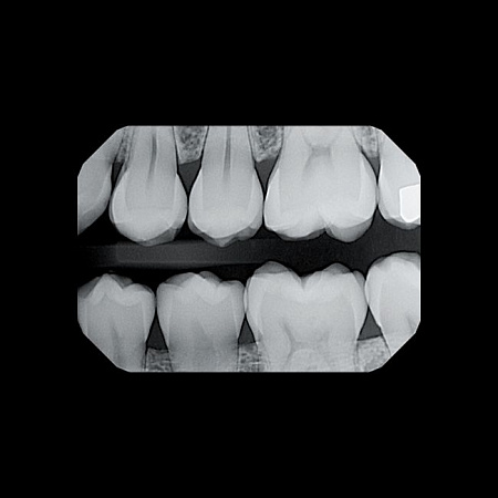 KaVo Gendex GXS-700 - система компьютерной радиовизиографии (сенсор №1)