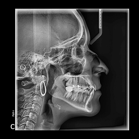 Vatech PaX-i 3D 10x8.5 - компьютерный томограф