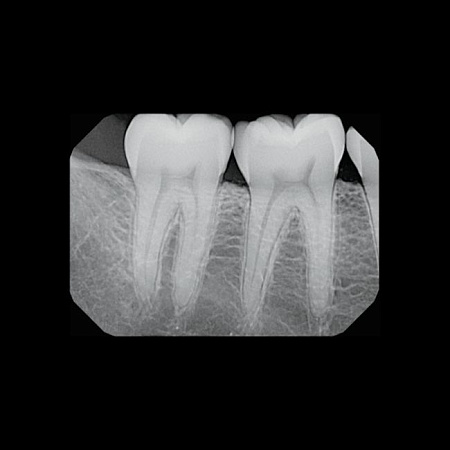 KaVo Gendex GXS-700 - система компьютерной радиовизиографии (сенсор №1)